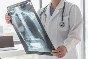 photo of doctor holding a scan of an xray of lungs with a comlication